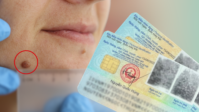 Theo luật: Nốt ruồi ở một số vị trí dưới đây không được tẩy